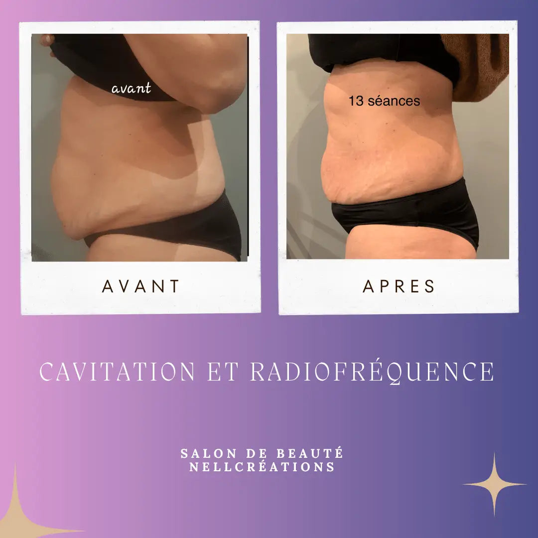 Avant et après traitement de cavitation et radiofréquence sur la zone abdominale dans un salon de beauté