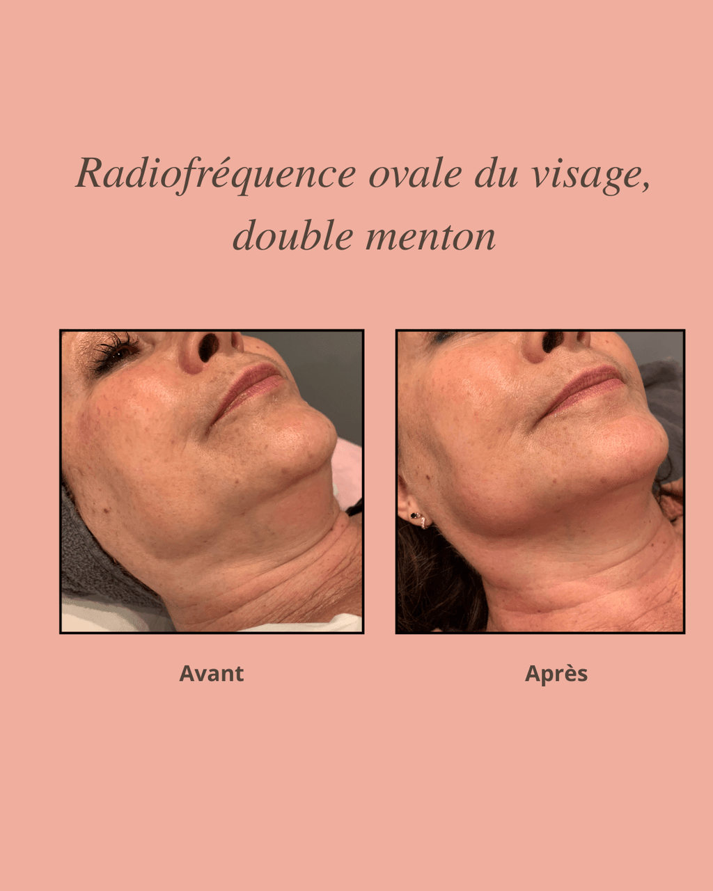 Radiofréquence ovale du visage et double menton - Nellcréations