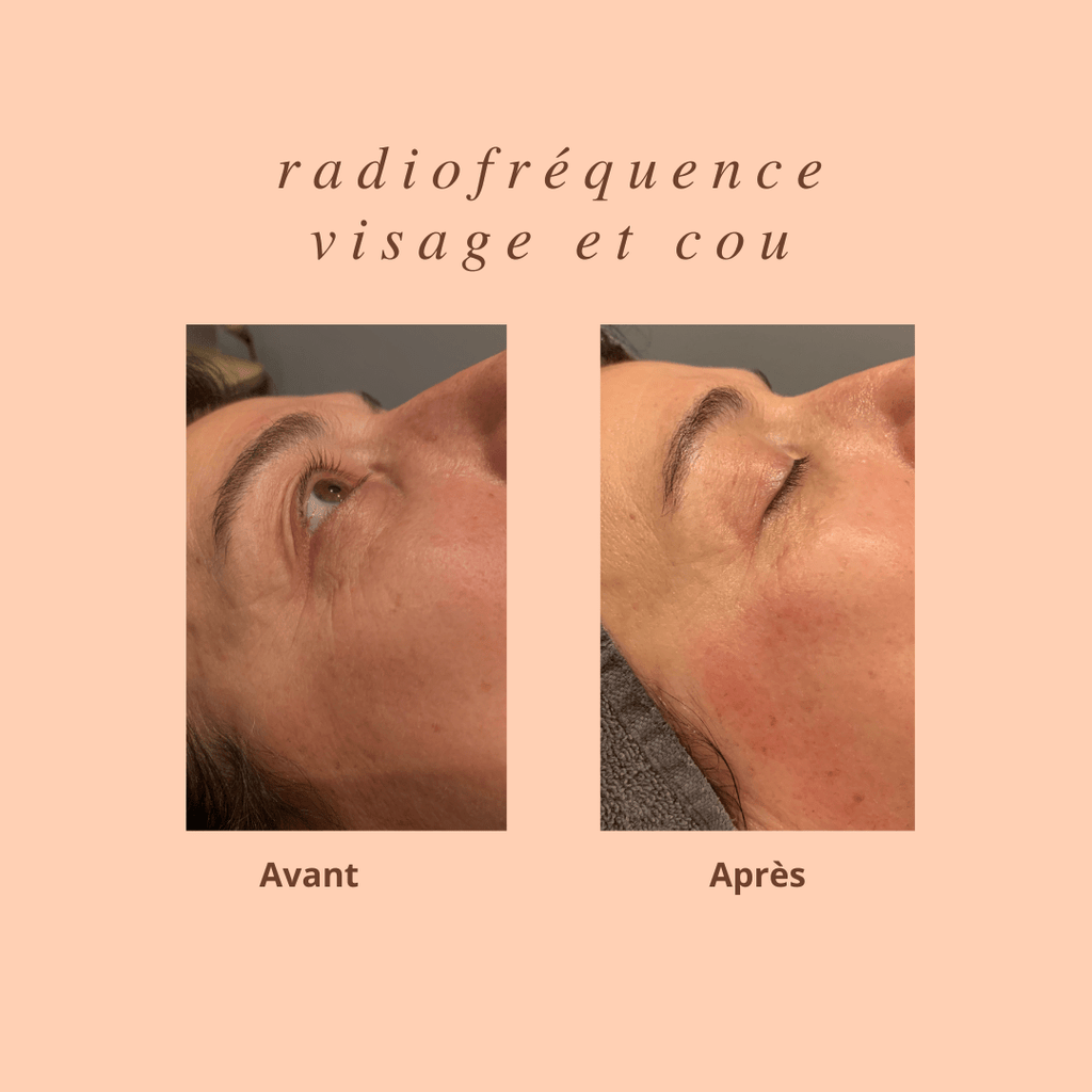 Radiofréquence visage et cou - Nellcréations